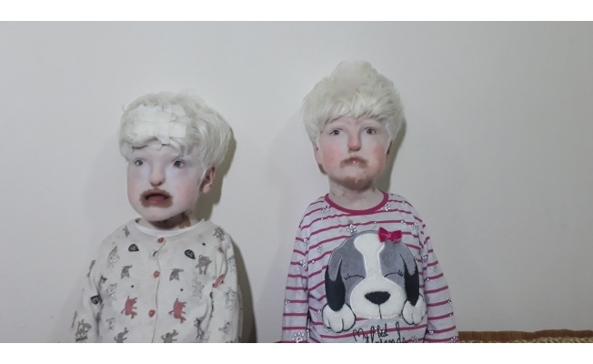 Albino kardeşler yardım bekliyor